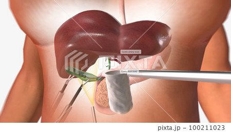 The Removal of the Gallbladder The Removal of the Gallbladder 100211023