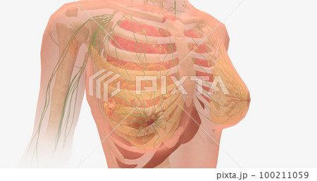Stage IV breast tumors are invasive and have spread beyond the localized area to the lungs, bones, liver, brain, or to distant lymph nodes. 100211059
