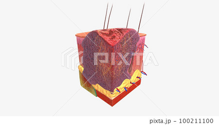 Basal Cell Carcinoma in Tissue, Stage III 100211100