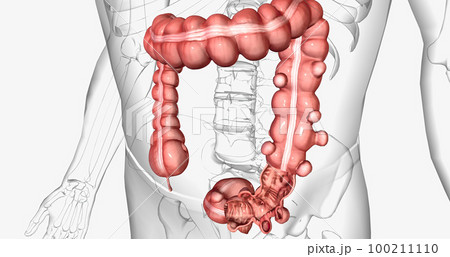 Diverticulosis is a condition characterized by the formation of diverticula in the walls of the intestines. 100211110