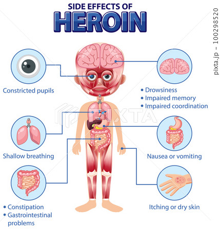 Human anatomy diagram cartoon style of Heroin side effects Human anatomy diagram cartoon style of Heroin side effects 100298520