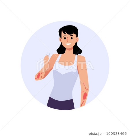 Woman having atopic dermatitis holding tablet for treatment flat style 100323466