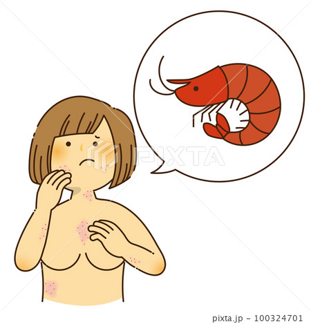 エビのアレルギーでかゆみが出ている女性 エビのアレルギーでかゆみが出ている女性 100324701