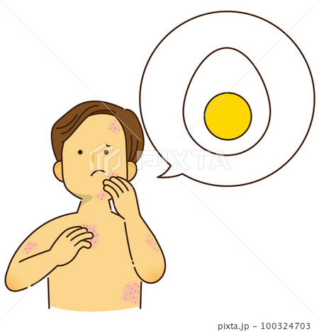 卵のアレルギーでかゆみが出ている女性 卵のアレルギーでかゆみが出ている女性 100324703