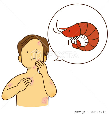 エビのアレルギーでかゆみが出ている男性 エビのアレルギーでかゆみが出ている男性 100324712
