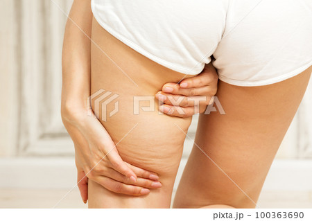 太もものセルライト / 若い女性 100363690