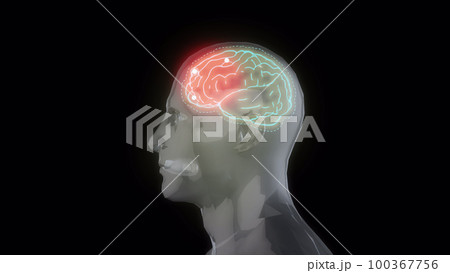 Medical 3d animation - showing a male getting a headache. 3d animation of a man having a headache. Medical 3d animation - showing a male getting a headache. 3d animation of a man having a headache. 100367756