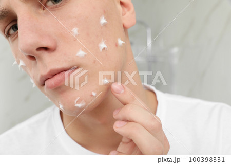 Teen guy with acne problem applying cream indoors, closeup Teen guy with acne problem applying cream indoors, closeup 100398331