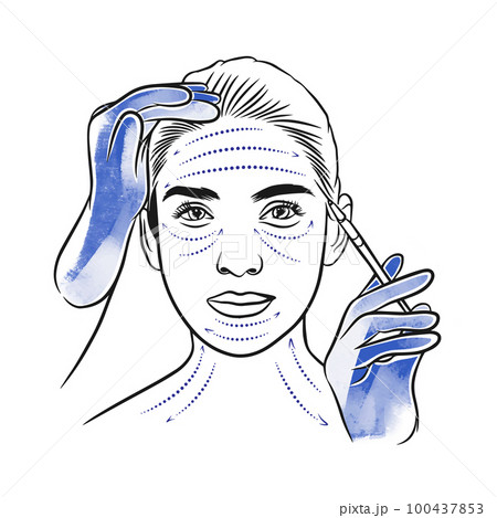 Botox, beauty injections, portrait of a girl with markup, syringe in gloved hands Botox, beauty injections, portrait of a girl with markup, syringe in gloved hands 100437853