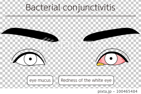 Medical illustration, line drawing illustration of eye disease, bacterial conjunctivitis 100465484