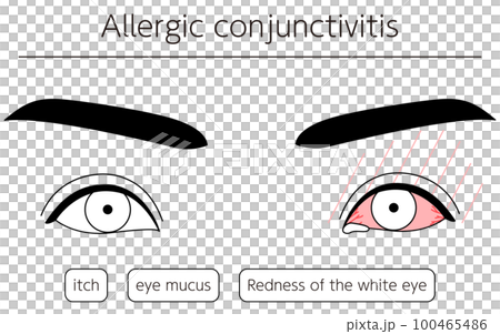 Medical illustration, line drawing illustration of eye disease/allergic conjunctivitis 100465486