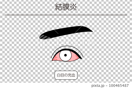 Medical illustration, line drawing illustration of eye disease and conjunctivitis 100465487