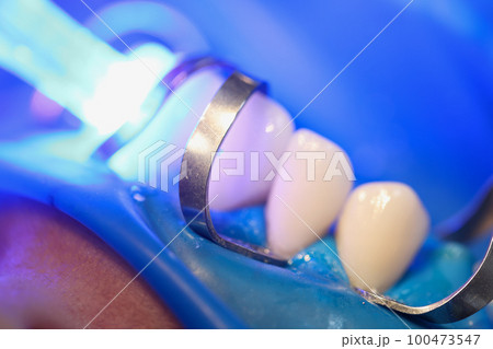 Light falling on teeth during installation of veneers in dental clinic closeup 100473547