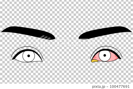 Medical illustration, line drawing illustration of eye disease, bacterial conjunctivitis Medical illustration, line drawing illustration of eye disease, bacterial conjunctivitis 100477691
