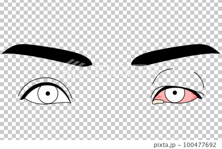 Medical illustration, line drawing illustration of eye disease, viral conjunctivitis Medical illustration, line drawing illustration of eye disease, viral conjunctivitis 100477692