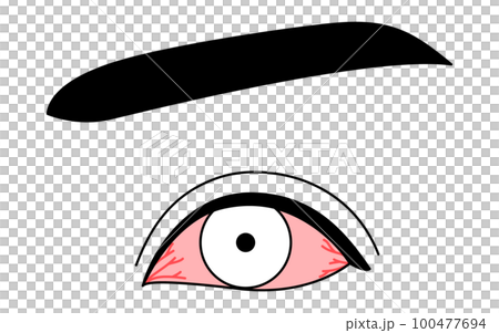 Medical illustration, line drawing illustration of eye disease and conjunctivitis Medical illustration, line drawing illustration of eye disease and conjunctivitis 100477694