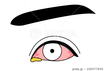 医療イラスト、眼病・細菌性結膜炎の線画イラスト 医療イラスト、眼病・細菌性結膜炎の線画イラスト 100477695