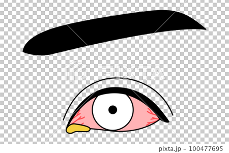 医療イラスト、眼病・細菌性結膜炎の線画イラスト 医療イラスト、眼病・細菌性結膜炎の線画イラスト 100477695