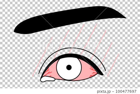 Medical illustration, line drawing illustration of eye disease/allergic conjunctivitis 100477697