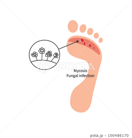 Foot with fungal skin disease 100486170