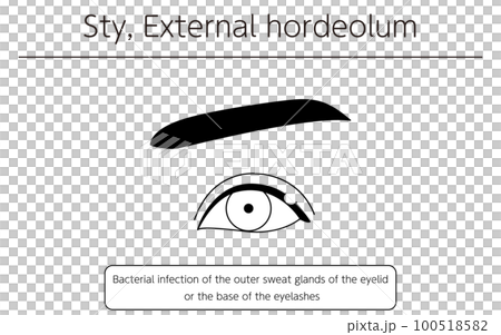 Medical illustration, line drawing illustration of eye disease / stye (outer hordeolum) 100518582