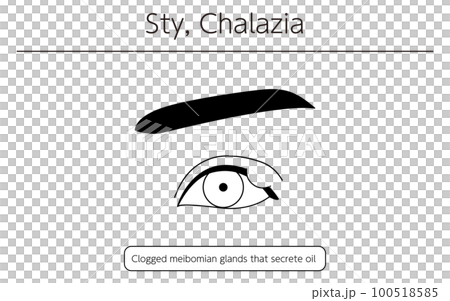 Medical illustration, line drawing illustration of eye disease / stye (chalazion) 100518585