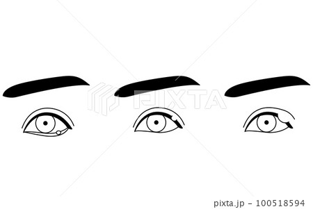 医療イラスト、眼病・ものもらい（内麦粒腫・外麦粒腫・霰粒腫）の線画イラスト 100518594