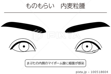 医療イラスト、眼病・ものもらい(内麦粒腫)の線画イラスト 医療イラスト、眼病・ものもらい(内麦粒腫)の線画イラスト 100518604