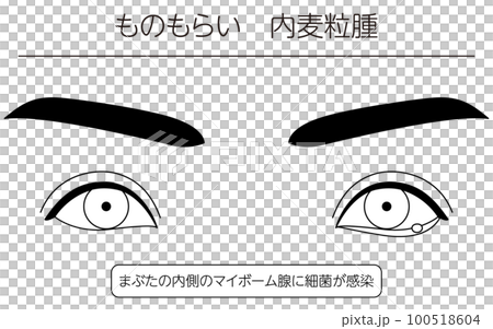 医療イラスト、眼病・ものもらい(内麦粒腫)の線画イラスト 医療イラスト、眼病・ものもらい(内麦粒腫)の線画イラスト 100518604