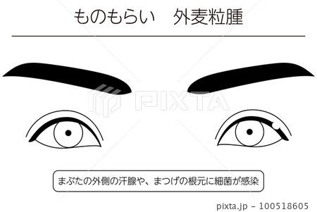 医療イラスト、眼病・ものもらい(外麦粒腫)の線画イラスト 医療イラスト、眼病・ものもらい(外麦粒腫)の線画イラスト 100518605