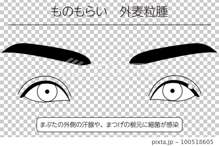 医療イラスト、眼病・ものもらい(外麦粒腫)の線画イラスト 医療イラスト、眼病・ものもらい(外麦粒腫)の線画イラスト 100518605