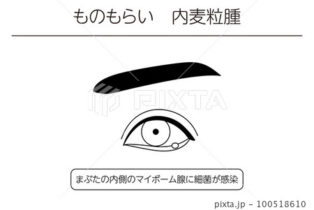 医療イラスト、眼病・ものもらい（内麦粒腫）の線画イラスト 100518610