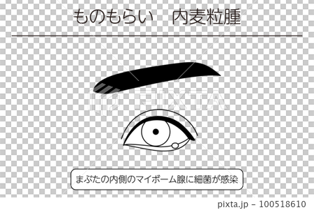 医療イラスト、眼病・ものもらい（内麦粒腫）の線画イラスト 100518610