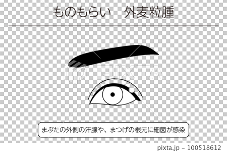 Medical illustration, line drawing illustration of eye disease / stye (outer hordeolum) 100518612