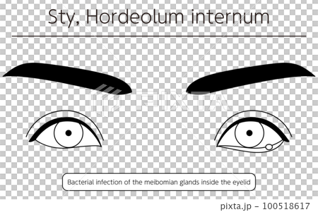Medical illustration, line drawing illustration of eye disease / stye (inner stye) 100518617