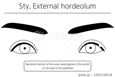 医療イラスト、眼病・ものもらい(外麦粒腫)の線画イラスト 医療イラスト、眼病・ものもらい(外麦粒腫)の線画イラスト 100518619