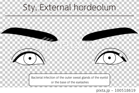 医療イラスト、眼病・ものもらい(外麦粒腫)の線画イラスト 医療イラスト、眼病・ものもらい(外麦粒腫)の線画イラスト 100518619