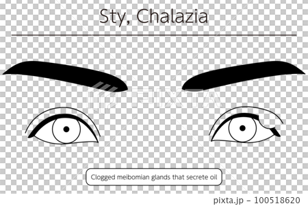 Medical illustration, line drawing illustration of eye disease / stye (chalazion) Medical illustration, line drawing illustration of eye disease / stye (chalazion) 100518620