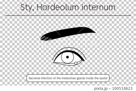 医療イラスト、眼病・ものもらい(内麦粒腫)の線画イラスト 医療イラスト、眼病・ものもらい(内麦粒腫)の線画イラスト 100518623