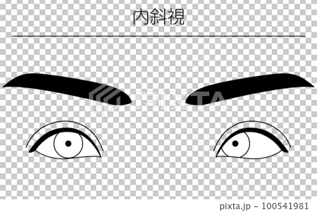 醫學插圖、眼病、斜視 100541981