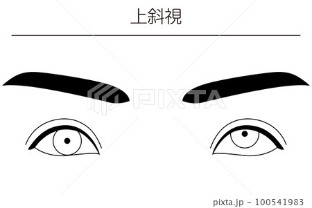 医療イラスト、眼病・斜視　上斜視の図解線画イラスト 100541983