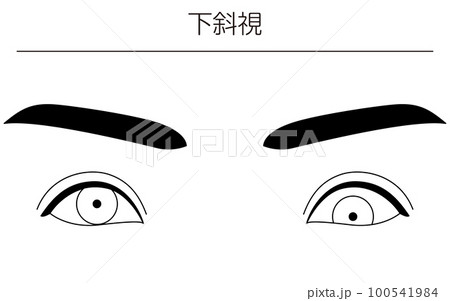 医療イラスト、眼病・斜視 上斜視の図解線画イラスト 医療イラスト、眼病・斜視 上斜視の図解線画イラスト 100541984