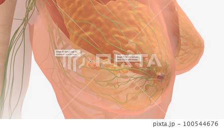Stage III breast tumors are invasive and have spread to the lymph nodes around the collar bone or those deep within the breast. Stage III breast tumors are invasive and have spread to the lymph nodes around the collar bone or those deep within the breast. 100544676