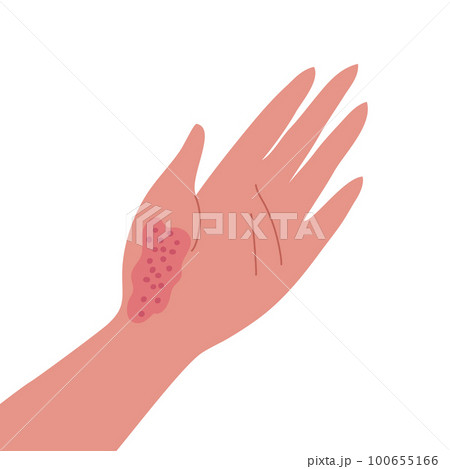 Dermatitis on the skin of a human hand 100655166