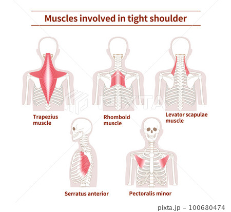 Muscle sets in the back that cause tight shoulder Muscle sets in the back that cause tight shoulder 100680474