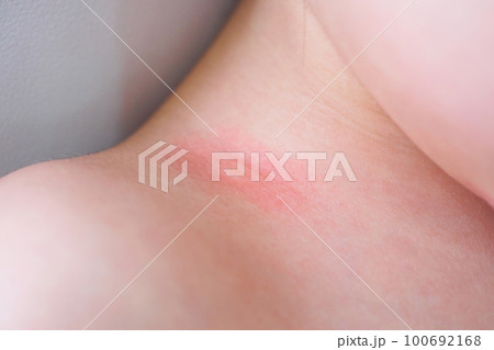 little asian girl skin rash and allergy with red spot cause by mosquito bite at neck little asian girl skin rash and allergy with red spot cause by mosquito bite at neck 100692168
