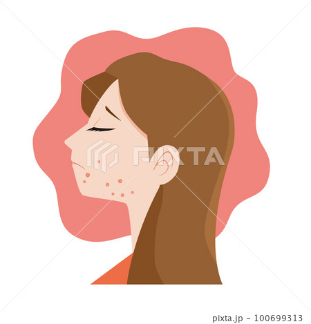 ニキビ肌荒れに悩む女性 100699313