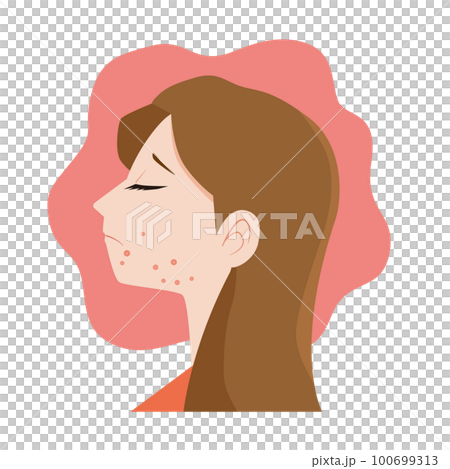 ニキビ肌荒れに悩む女性 100699313