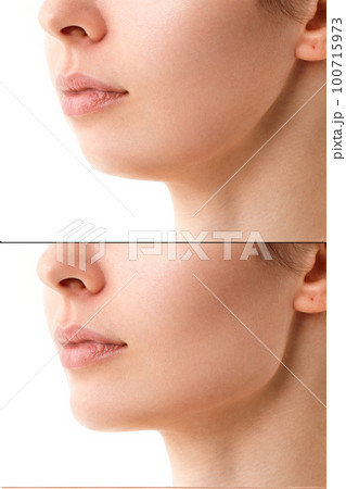 Close-up portrait of a woman before and after a chin correction procedure with neck liposuction. Fillers on the cheekbones and chin. The result of the procedure in a plastic surgery clinic. Close-up portrait of a woman before and after a chin correction procedure with neck liposuction. Fillers on the cheekbones and chin. The result of the procedure in a plastic surgery clinic. 100715973