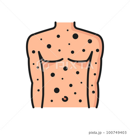 Allergy rash or acne color line icon. Seasonal health problem, disease or allergic reaction outline vector symbol. Food or cloth material allergy symptom pictogram or icon with skin rash on man torso 100749403